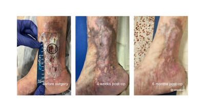 Restorative effect of replacing diseased vein with fully biological P-TEV personalized tissue engineered vein Restorative effect of replacing diseased vein with fully biological P-TEV personalized tissue engineered vein