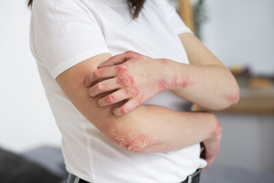 Chronic Eczema