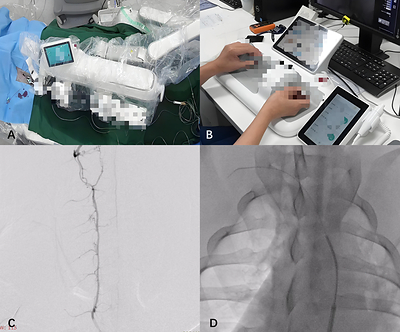 The practical application scenario, cerebral angiography and navigation of the guiding catheter. (A) The slave manipulator on the DSA table for navigation of the guiding catheter. (B) The physician’s intraoperative manipulation scenario. (C) The 5F angiographic catheter was inserted into the VA for angiography. (D) Navigation of the 8F guiding catheter with the assistance of an MPA catheter and a guidewire.